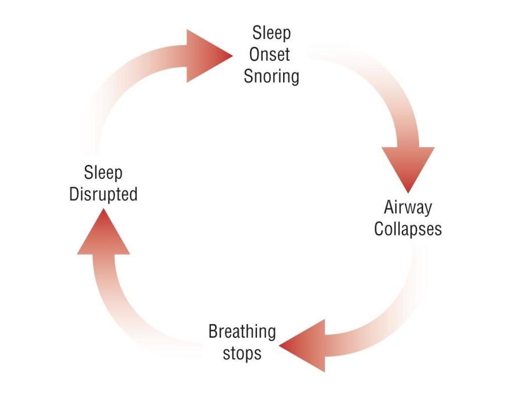 SNORING & OBSTRUCTIVE SLEEP APNOEA the procedure Snoring & Obstructive Sleep Apnoea