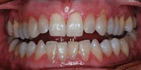 Tooth Whitening before Teeth Whitening