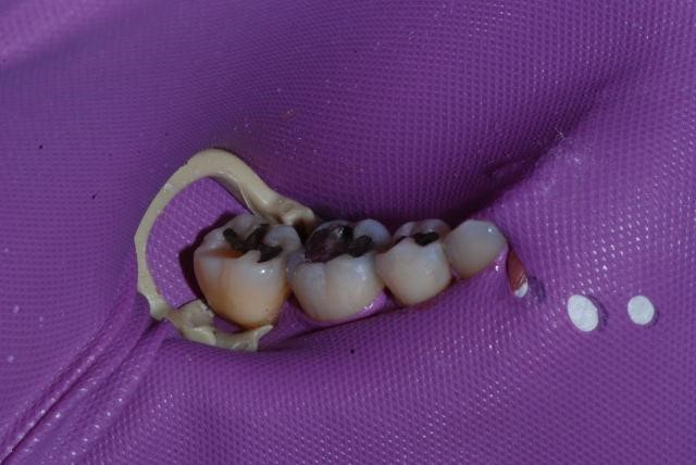 same mouth with rubber dam Anxious Patients