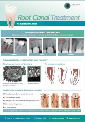Root Canal Graphic