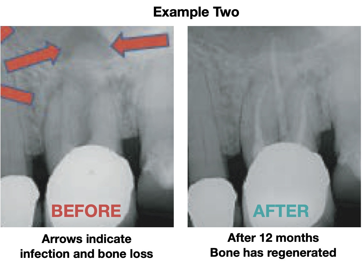 RCT 2 Root Canal Treatment