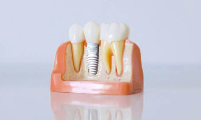 Zirconia implant Zirconia implant
