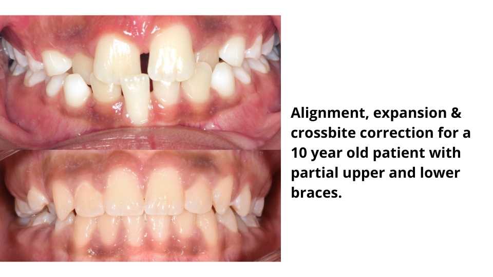 Orthodontics_braces_Before_After_11zon Orthodontics braces Before After