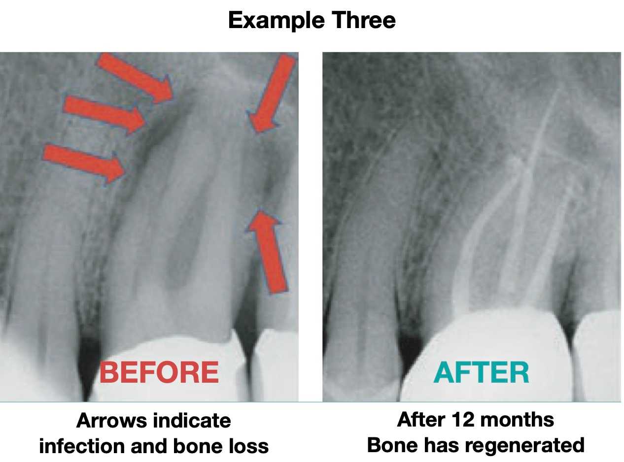 RCT-3_11zon root canal example