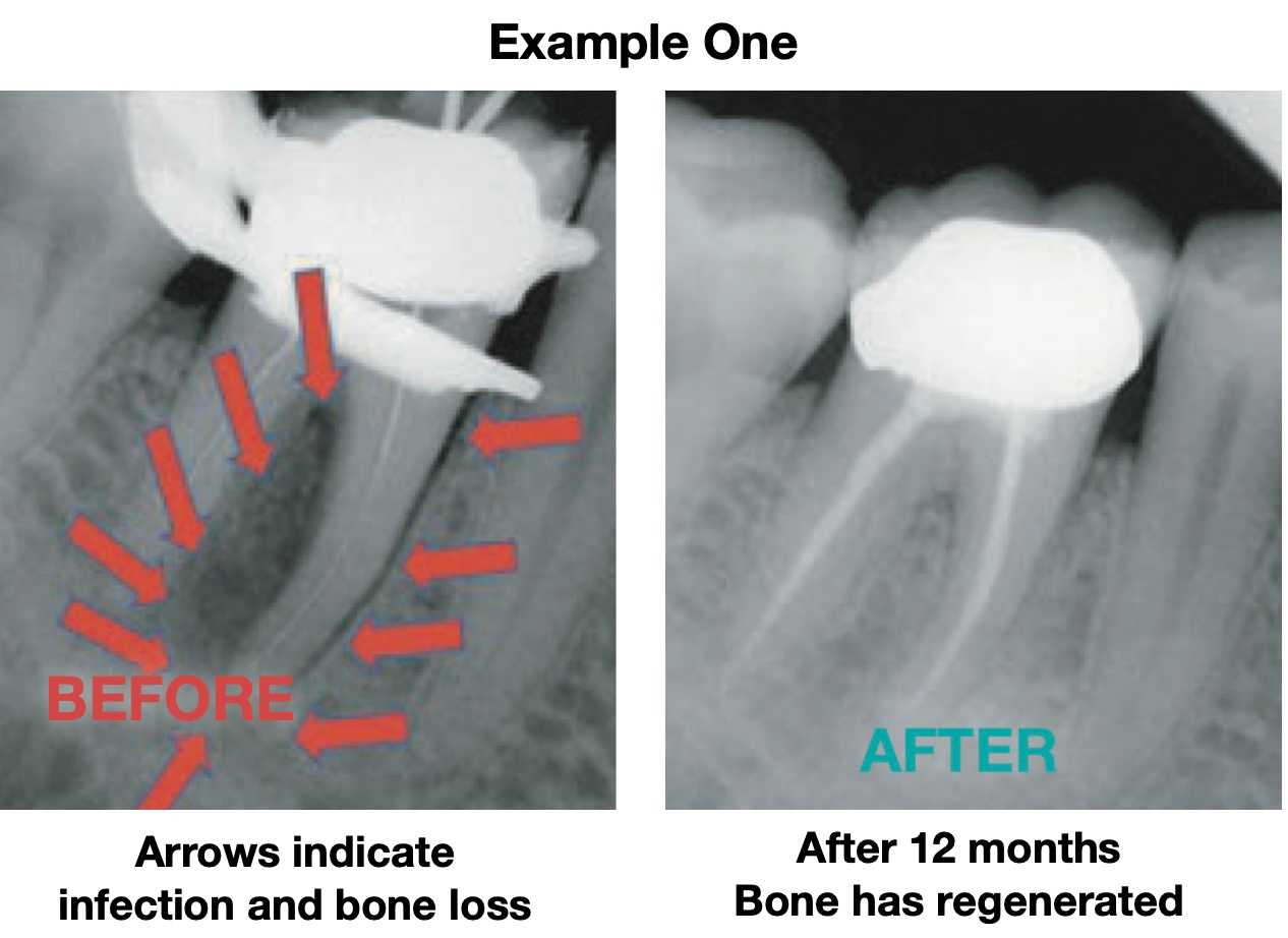 RCT-One_11zon root canal explained