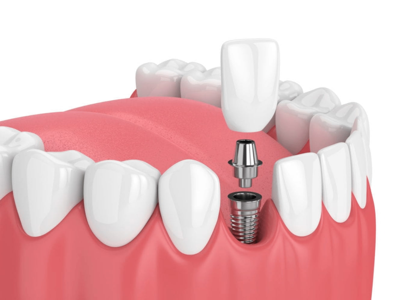 tooth single dental implants